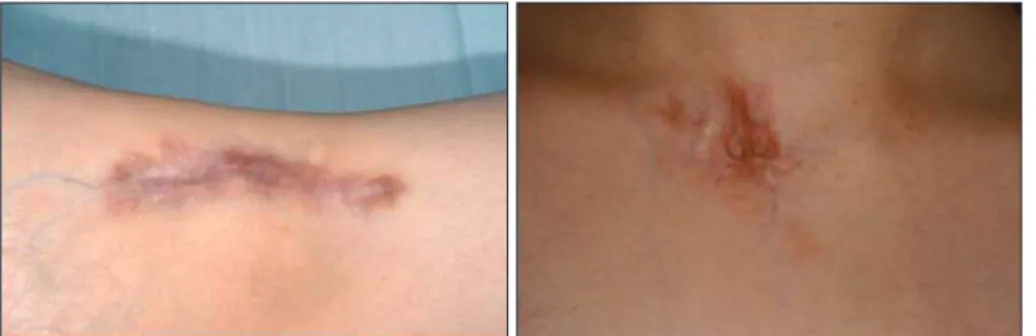 Fig. 4. Triamcinolone의 주사 이후 반흔 주위의 위축 및 색소 변형. Left : 우측 발목 부위. Right : 경부 전면 부위.