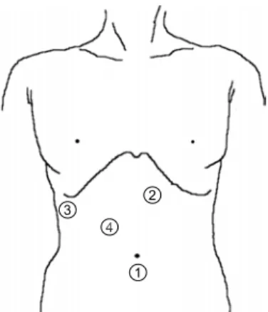 Fig.  1.  This  shows  the  position  of  the  trocars.