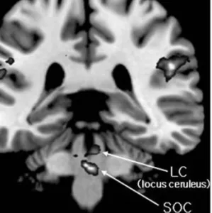 Fig. 6. Subcortical response to target stimuli (p＜0.001). 36) 소음 환경에서 간헐적인 목표음을 인지하는 oddball 방식 의 음 자극에 대해 뇌간의 상올리브핵(soc)과 청반(locus  ceruleus)에서  목표음  인지에  상응하는  활성화가  뚜렷하 게 관찰되었다