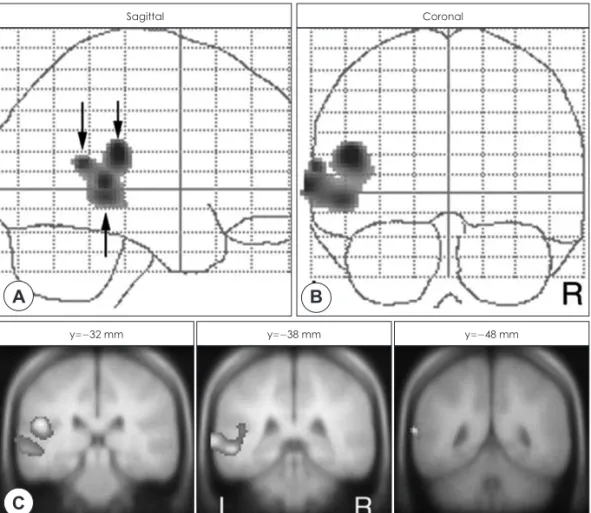 Fig. 8. Positron-emission tomography shows foci of neural activity in auditory cortical sites in the temporal lobe from a  group of patients with tinnitus perceived in the right ear (Lockwood 1998).