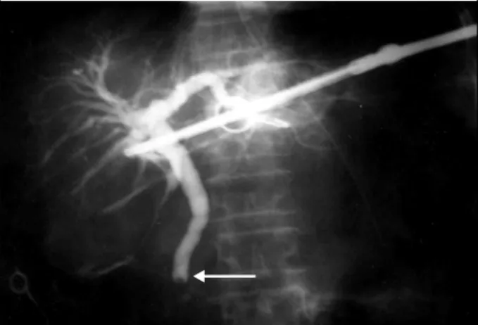 Table  1.  Detection  of  choledocholithiasis  by  ERCP ꠚꠚꠚꠚꠚꠚꠚꠚꠚꠚꠚꠚꠚꠚꠚꠚꠚꠚꠚꠚꠚꠚꠚꠚꠚꠚꠚꠚꠚꠚꠚꠚꠚꠚꠚꠚꠚꠚꠚꠚꠚꠚꠚꠚꠚꠚꠚꠚꠚꠚꠚꠚꠚꠚꠚ