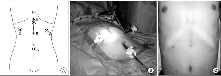 Fig.  2.  A.  The  port  insertion  site  illustrated.  Just  below  the  umbilicus  a  10  mm  trocar  was  inserted  for  camera