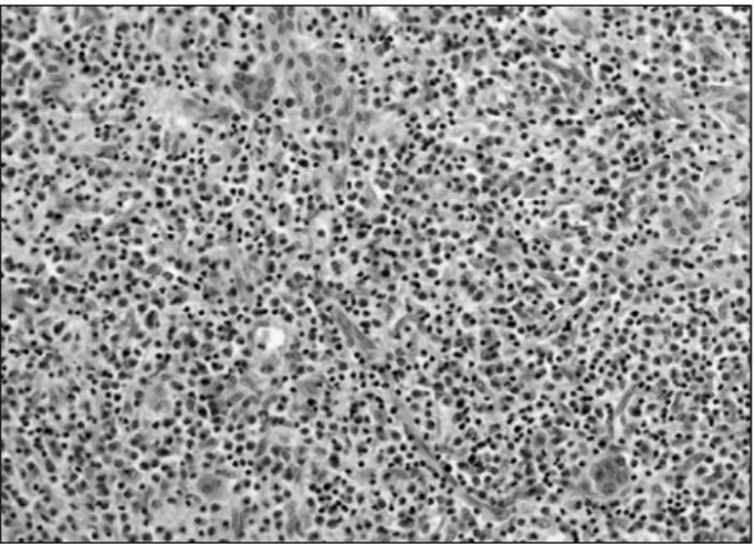 Fig.  4.  Massive  eosinophilic  infiltration  (H&amp;E  stain;  ×200).