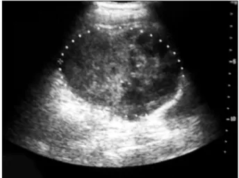 Fig.  1.  Plain  film  of  the  abdomen  showed  a  large  ovoid  homogenous  opacity  mass  (tarrow)  in  the  Rt