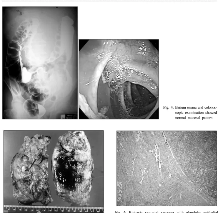 Fig.  4.  Barium  enema  and  colonos- colonos-copic  examination  showed  normal  mucosal  pattern.
