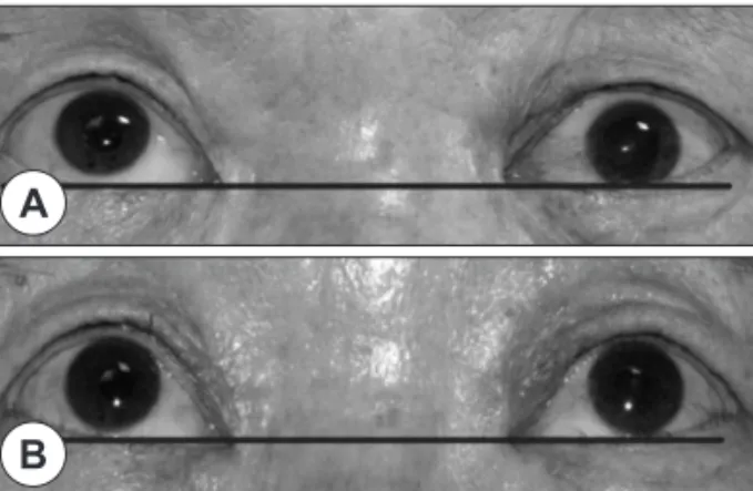 Fig. 2. A : Axial T2 weighted MRI scan shows high signal intensity in the left frontal sinus