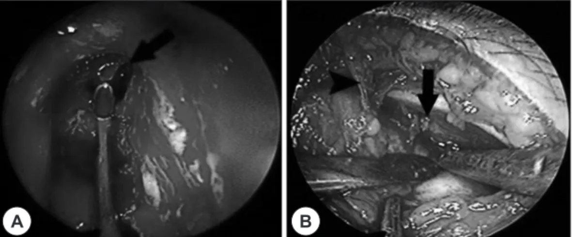 Fig. 4. A : 1 day after surgery, left supraorbital abscess was completely removed at the coronal CT scan