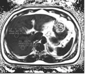 Fig. 4. Uneven distribution of fat in the liver. It measures  11.5% in segment 7 and 5% in  segment 8