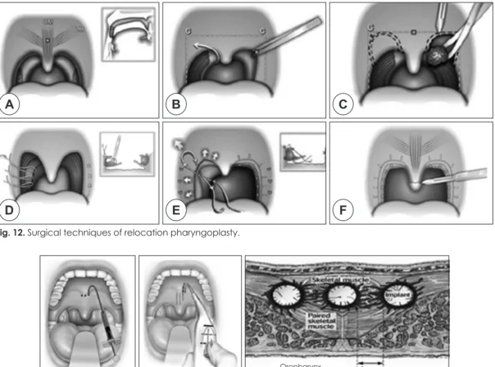 Fig. 13. The Pillar implant technique. The implant sites at the junction of the hard and soft palate are marked in the  midline and 2 mm on each side of the midline