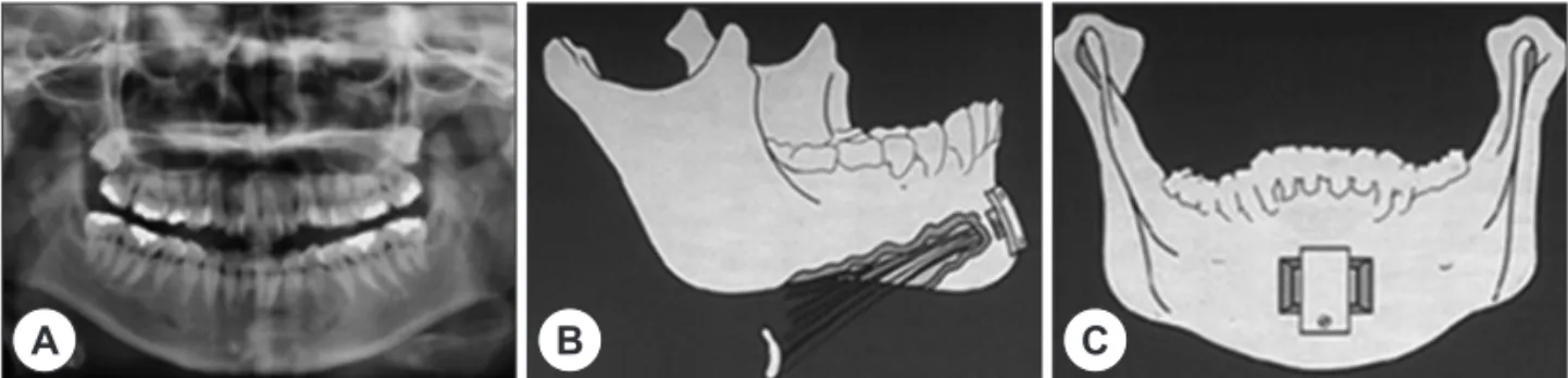 Fig. 16. Genioglossus advancement. A : Preoperative panoramic view. B : Postoperative lateral view
