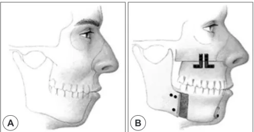 Fig. 18. Maxillomandibular advancement. A : Before surgery. B : After surgery.