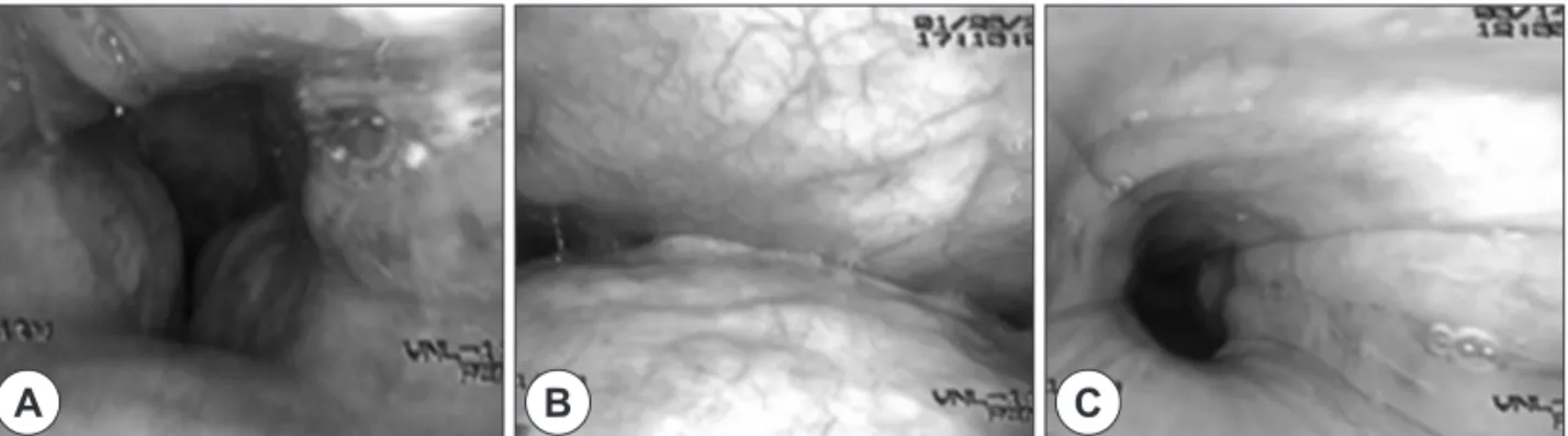 Fig. 5. Obstructive pattern of retropalatal area. A : Sagittal obstruction. B : Anteroposterior obstruction