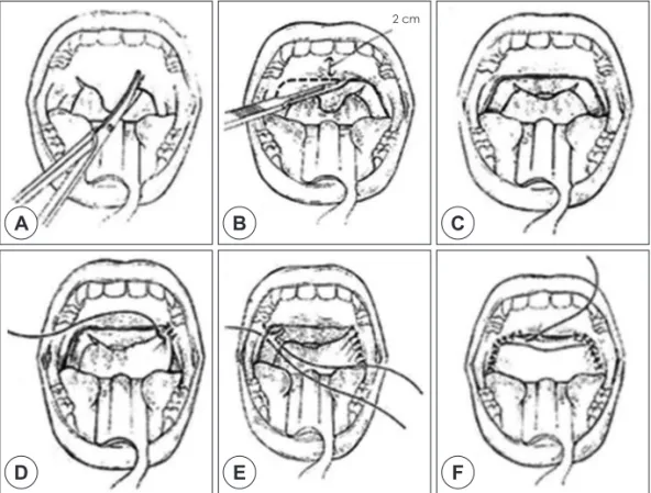 Fig. 6. Surgical techniques of UPPP.
