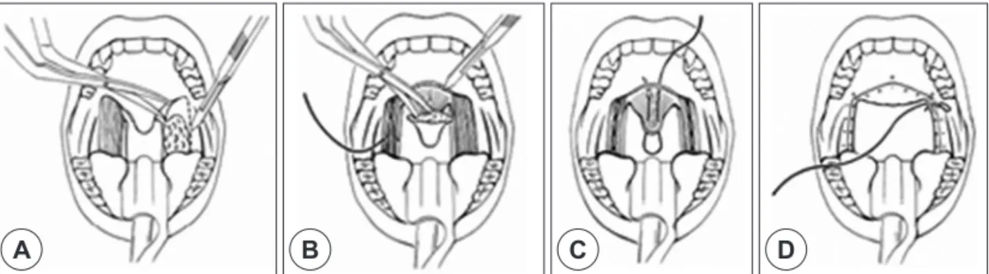 Fig. 7. Surgical techniques of extended UPF. 