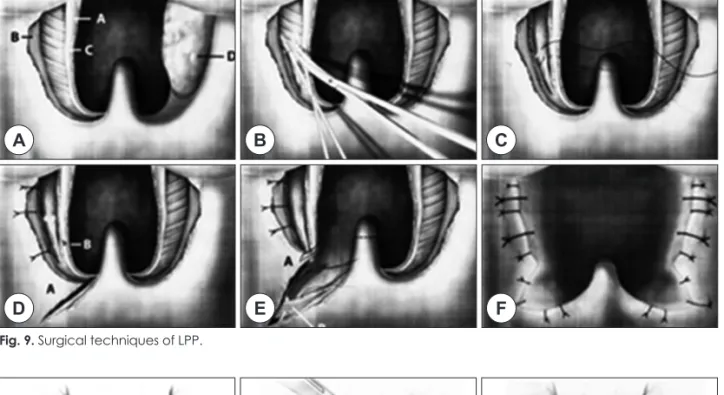 Fig. 10. Surgical techniques of UP2. 