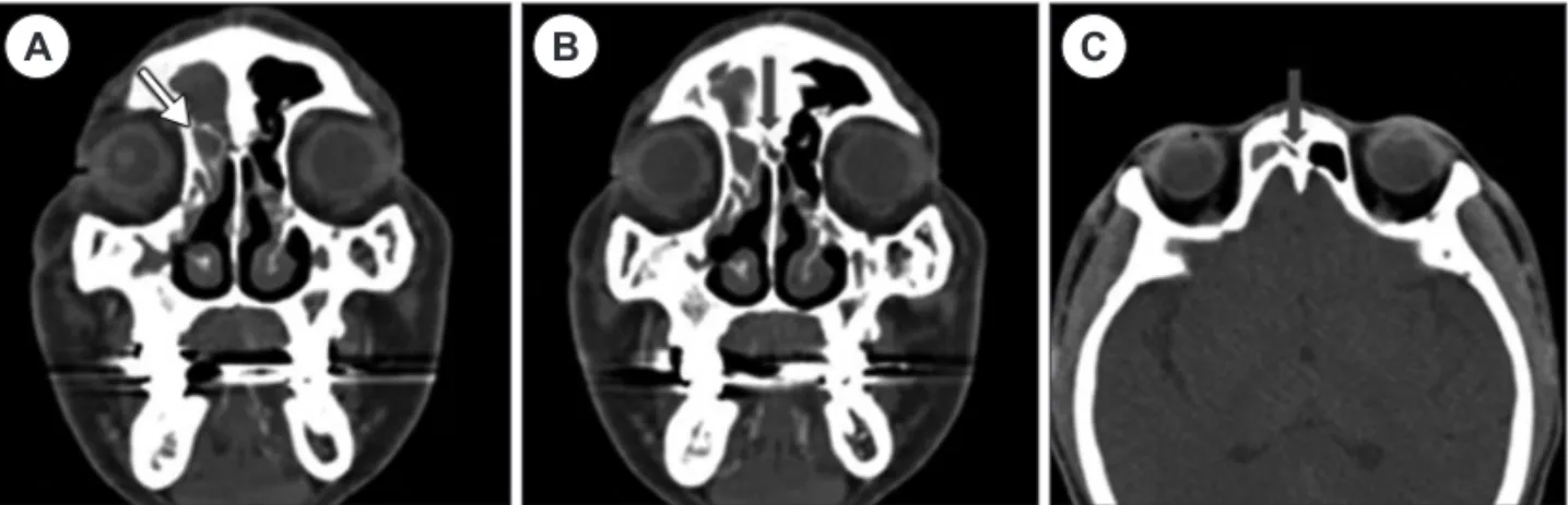 Fig. 1. Preoperative paranasal sinus CT scans show abnormal air cells and thick bony wall narrowing frontal ostium