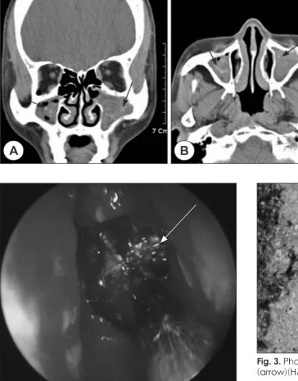 Fig. 1. Preoperative CT scan: Coro- Coro-nal (A) and Axial (B) CT scan show a  soft tissue density (arrow) in both  ma-xillary sinuses.