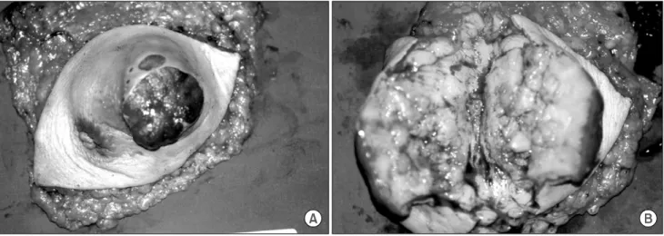 Fig.  1.  The  chest  X-ray  shows  a  huge  mass  shadow  at  the  area  of  Lt  breast  (arrow).
