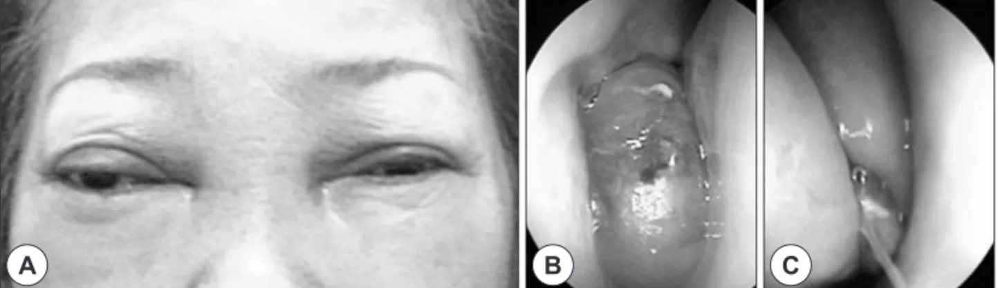 Fig. 1. Physical examination and endoscopic finding. A : Intercanthal swelling and telecanthus are observed