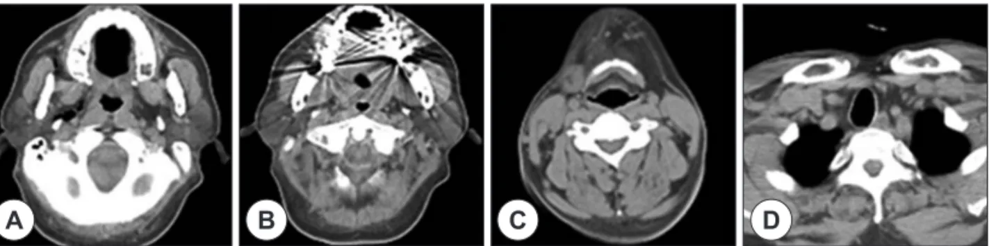 Fig. 2. Axial computed tomography taken 6 days after tonsillectomy. Upper oropharyngeal level (A) : the amount of  air bubbles in parapharyngeal space was much decreased compared to initial scan