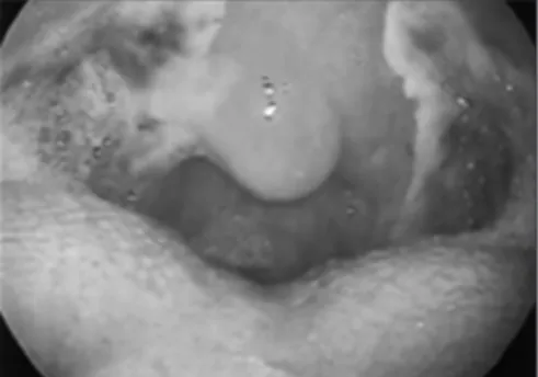 Fig. 4. Simple illustration of oropharynx after tonsillecto- tonsillecto-my. It shows a porus surface of right upper tonsillar fossa  that allowed air to track through parapharyngeal space  (arrow).