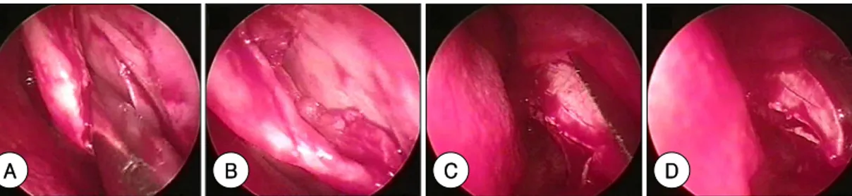Fig. 2. A, B：Intraoperative findings of Mladina type III. Mucosal flap was elevated after anterior vertical incision