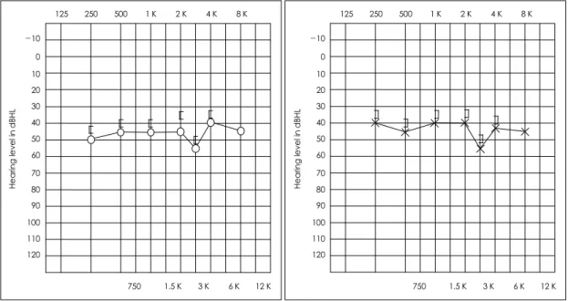 Fig. 1. Pure tone audiogram on the first day. 