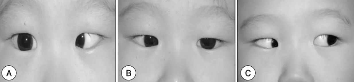 Fig. 1. Photographs show abduction defect (-4), esodeviation of 30 PD (Prism diopter) in the right eye