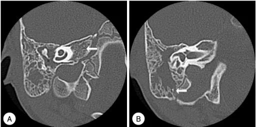 Fig. 3. A：Axial CT image shows no inflammation of the petrous bone. B：Coronal CT image shows erosive mastoid septa (White arrow)