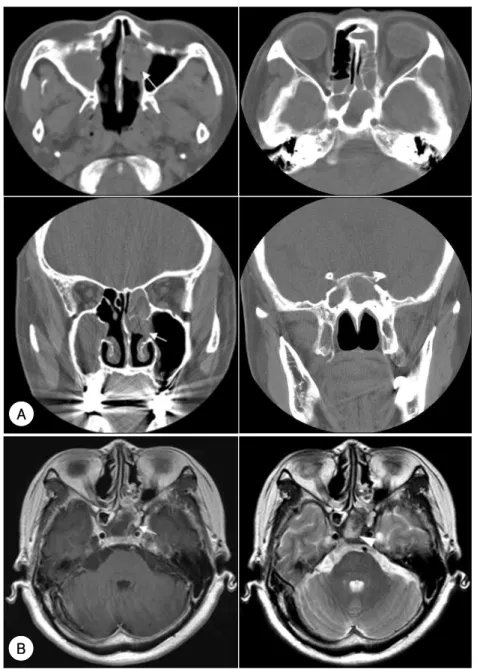 Fig. 1. Preoperative paranasal CT (A) and brain MRI (B) 2 years ago. A：Paranasal CT images show soft tissue density in left nasal cavity, ethmoid and sphenoid sinus