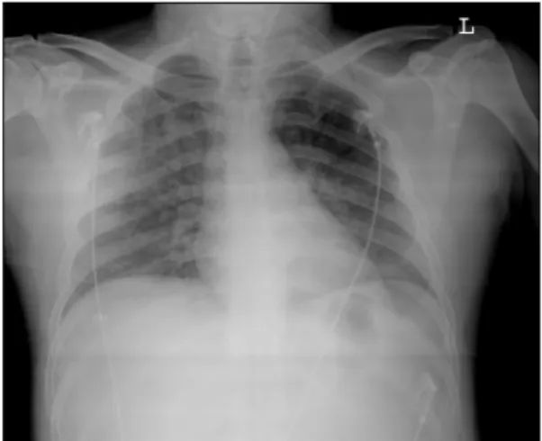 Fig. 2. Postoperative 5 day chest radiography shows ne- ne-arly resolved pulmonary edema