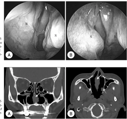 Fig. 3. Postoperative, 12 months af- af-ter surgery, nasal endoscopic view shows septal protrusion and  decre-ased volume of the nasal cavity (S：