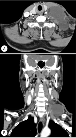 Fig. 1. Neck computed tomography shows 9×4 cm sized  low density fluid collection at the left supraclavicular area (A：Axial view