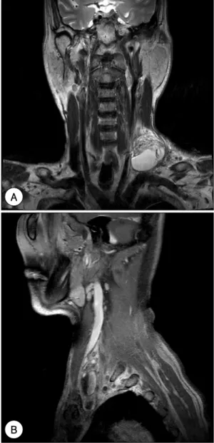 Fig. 3. Neck magnetic resonance image shows 6×2 cm  sized fluid-fluid leveled cystic lesion at the left  supracla-vicular area and collapsed left internal jugular vein due to large fluid collection (A：T2 coronal view