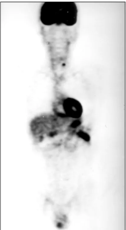 Fig.  2.  Neck  CT  scan  showing  a  1cm  sized  lower  density  nodule  in  left  lobe  of  thyroid  gland  with  no  enlarged  LNs.