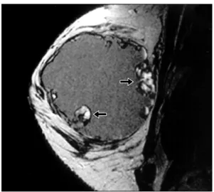 Fig.  2.  Ultrasonogram  shows  a  large  cystic  mass  with  irregular  margin  and  heterogenous  echogenicity,  measuring  5.6  cm  in  transverse  diameter