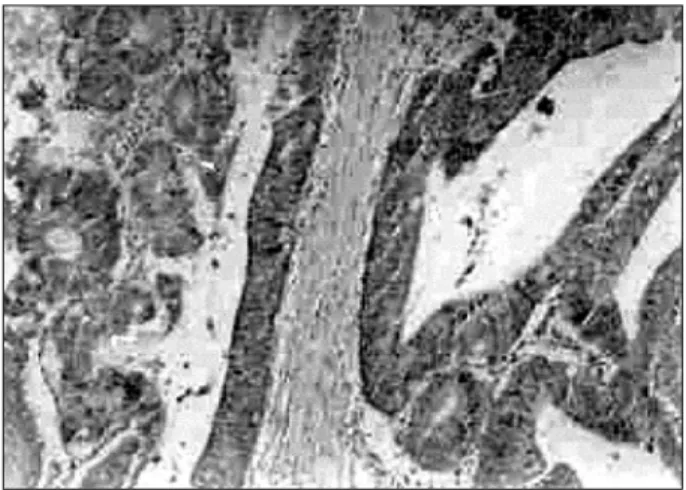 Fig.  1.  Immunohistochemical  staining  of  COX-2  in  a  representative  section  of  colorectal  carcinoma  (×100)