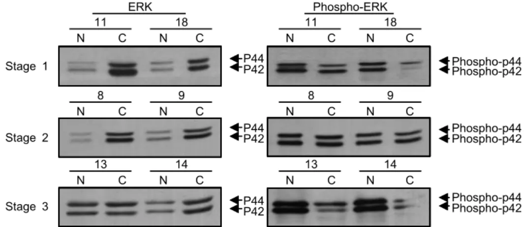 Fig.  3.  Levels  of  MAPKs  in  the  representative  breast  cancers  and  paired  normals  according  to  tumor  stages