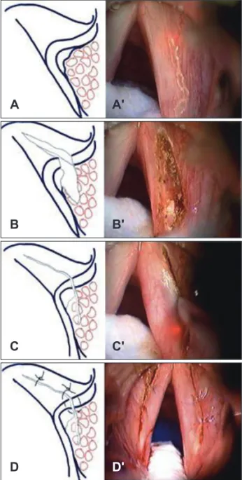 Fig. 2. Coronal section of the right vocal fold (A) and in- in-traoperative view (A’); the cover, ligament, and vocal  muscle are reduced longitudinally using the CO2 laser,  while preserving the medial vibrating portion (B and B’)