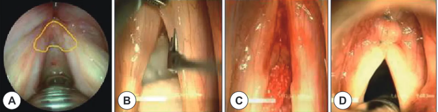 Table 2. The change of fundamental frequency after vocal fold shortening and recreationof anterior commissure Preoperative F0 Postoperative 3 months F0 Postoperative 6 months F0