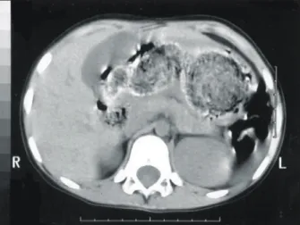 Fig.  4.  Barium  study  shows  a  large  intragastric  filling  defect,  which  composed  of  accumulated  ingested  material.