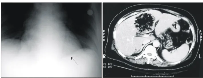 Fig.  2.  Operative  findings  of  ruptured  pyogenic  abscess  Purulent  material  in  upper  peritoneal  cavity  (left)  and  a  ruptured  abscess  cavity  behind  the  gall  bladder  (right)  are  noted.