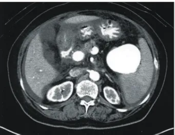 Fig.  2.  Endoscopic  view  of  esophagogastric  junction.  Continuous  oozing  was  observed  without  definite  esophageal  varix.