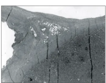 Fig.  5.  Microscopic  finding  of  the  resected  specimen  (H&amp;E,  ×100). 