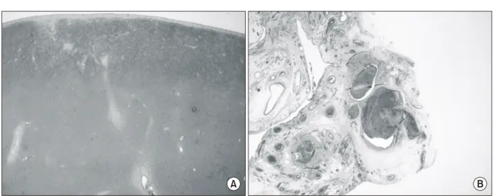 Fig.  5.  Microscopic  pathologic  finding  shows  hemorrhagic  necrosis  with  thrombus  in  spleen  ((A)  H&amp;E  stain  ×40,  (B)  H&amp;E  stain  ×100).
