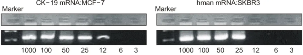 Table  2.  Relationship  between  expression  of  bone  marrow  mam- mam-maglobin  and  age  and  TNM  staging