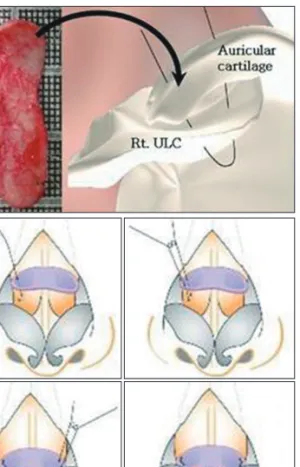 Fig. 4. The modified technique involves the placement  of conchal graft in a dorsally concave fashion in  accor-dance with natural curvature of the conchal cartilage  (A)
