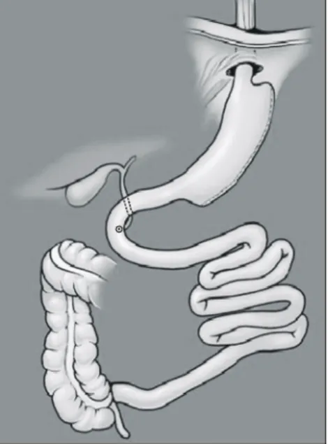 Fig.  1.  Isolated  vertical  sleeve  gastrectomy  without  duodenal  switch.