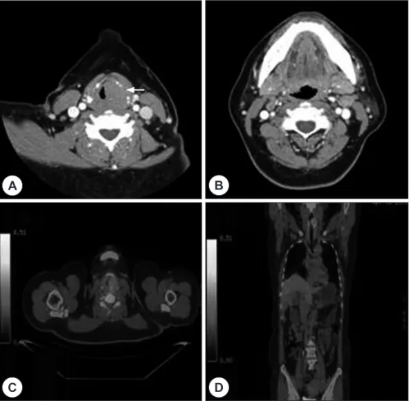Fig. 1. Preoperative CT scan. Axial image reveals huge well-demarcated, non-enhanced mass on left glottis (A) (white arrow head) and multiple lymphatic metastasis on left side of lateral neck, level II, III, IV (B)(white arrow head)