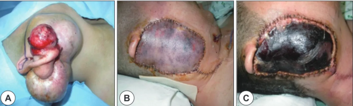 Fig. 1. Sequential change from preoperative state to venous engorgement in case #1. Initial finding (A), postopera- postopera-tive 2 nd  day (B), postoperative 24 th  day (C).